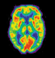 PET scans of a normal brain.