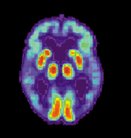 PET scans of an Alzheimer’s Disease brain.