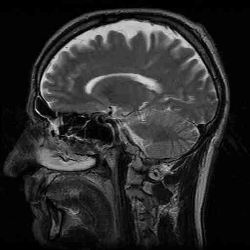 MRI of the head.