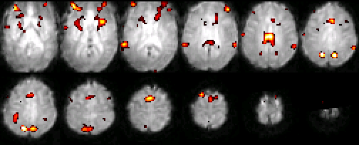 A typical set of functional MRI images, where an activation map is overlaid on a normalized single subject functional scan.  The activation is related to the control of auditory spatial selective attention.