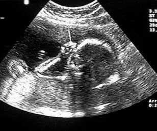 A typical 2D real-time image obtained during an ultrasound scan.