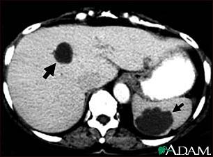 Cysts in the liver and spleen appear in a CAT scan image.