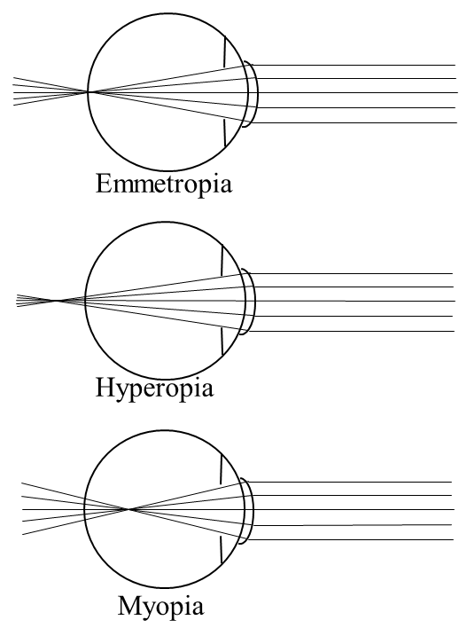 Parallel light rays focus on the retina in Emmetropia, behind the retina in Hyperopia, and before the retina in Myopia.