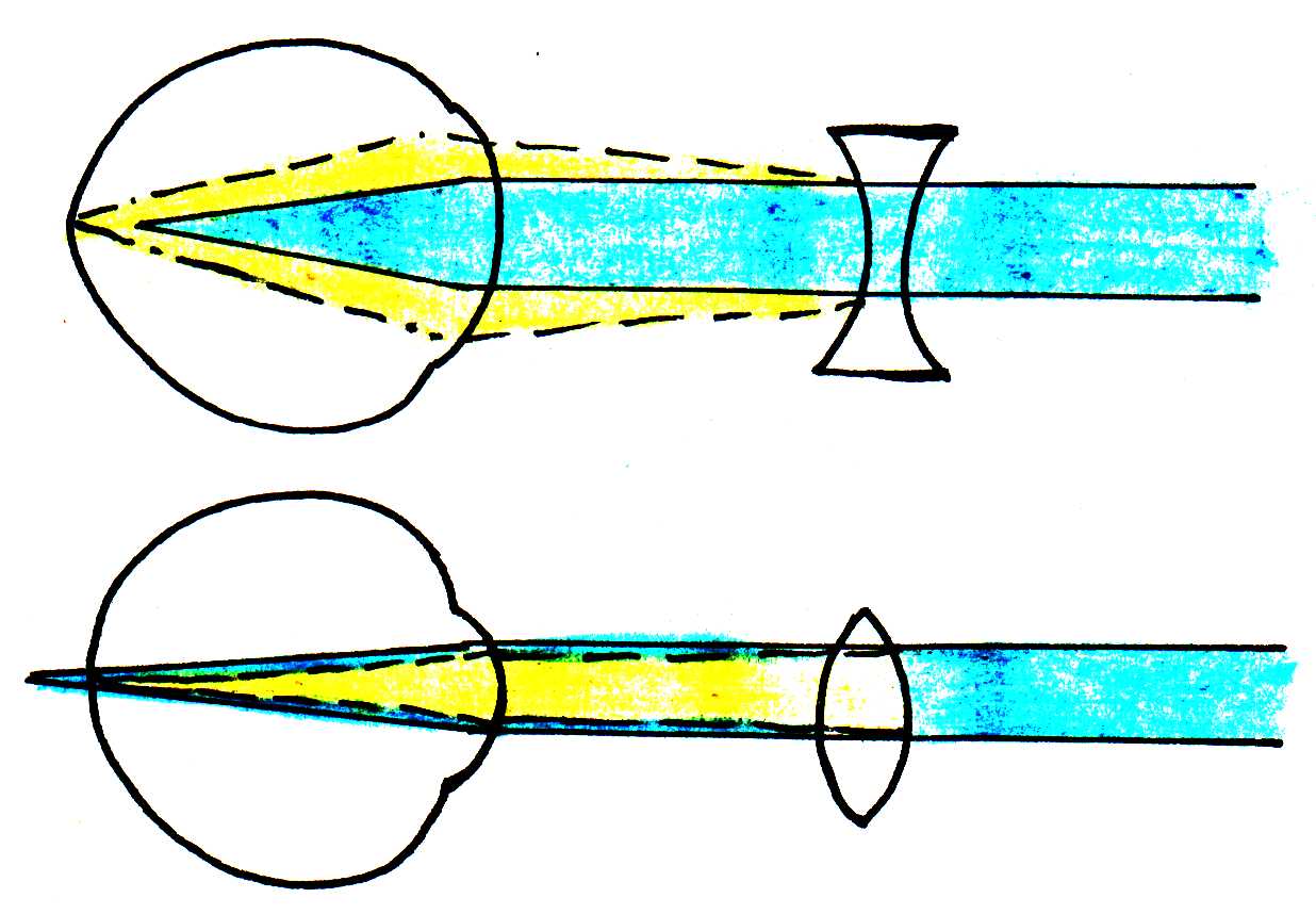 A convex lens corrects Hyperopia, and a concave lens corrects Myopia.